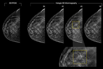 Projeto Screening de Mama